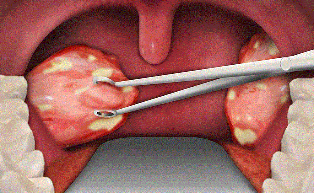 Tonsil əməliyyatı necə aparılır?