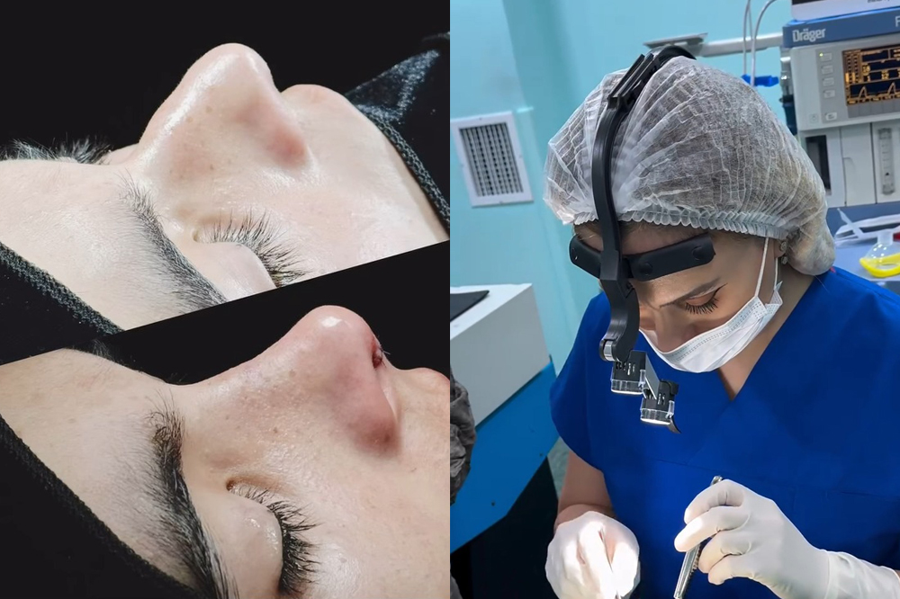 Rinoplastika: Daha təhlükəsiz və təbii yanaşma